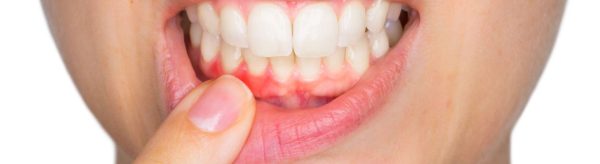 12 Arsye pse ju Dhëmbin Mishrat e Dhëmbëve dhe si t’i Trajtoni Shqetësimet