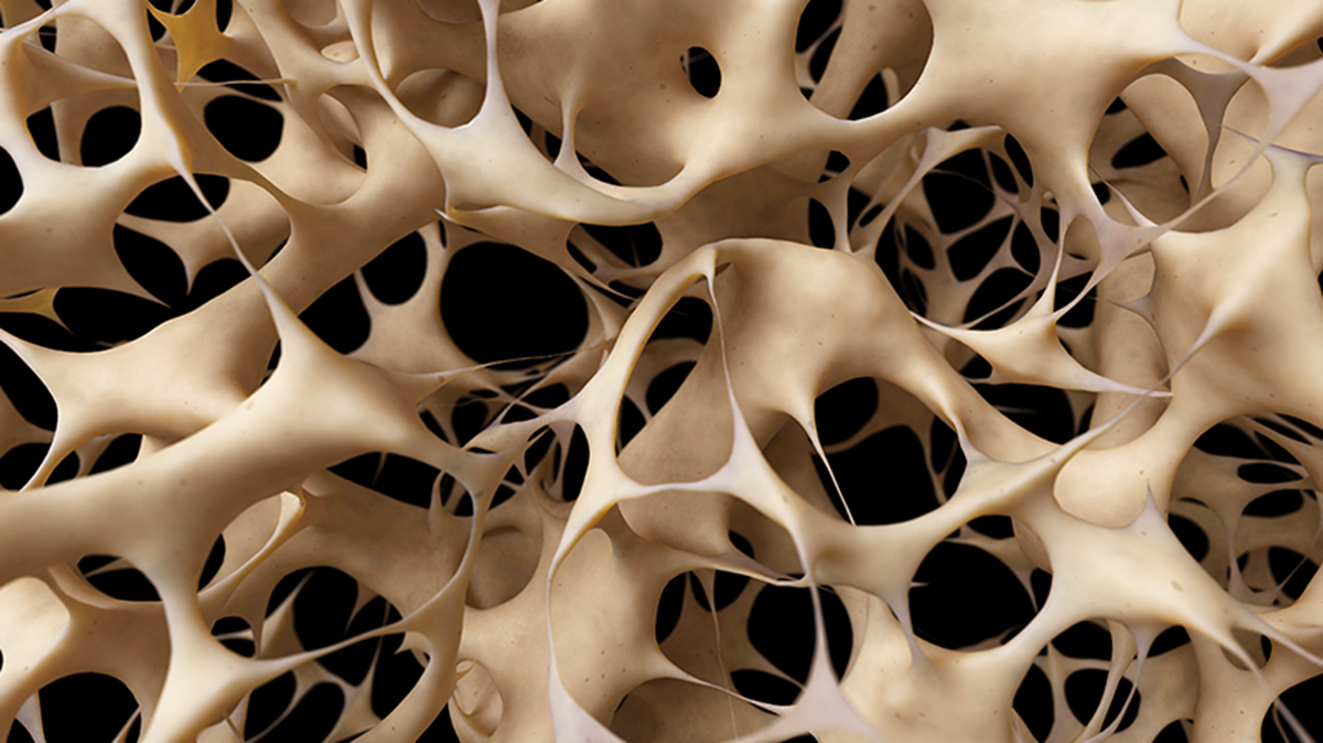 Osteoporoza - Shtohet Një Tjetër Faktor Rreziku
