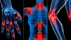 Artriti dhe Artralgia - Sëmundjet që Dëmtojnë Kyçet dhe Nyjat