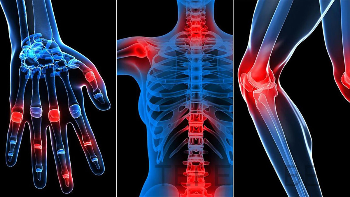 Artriti dhe Artralgia - Sëmundjet që Dëmtojnë Kyçet dhe Nyjat