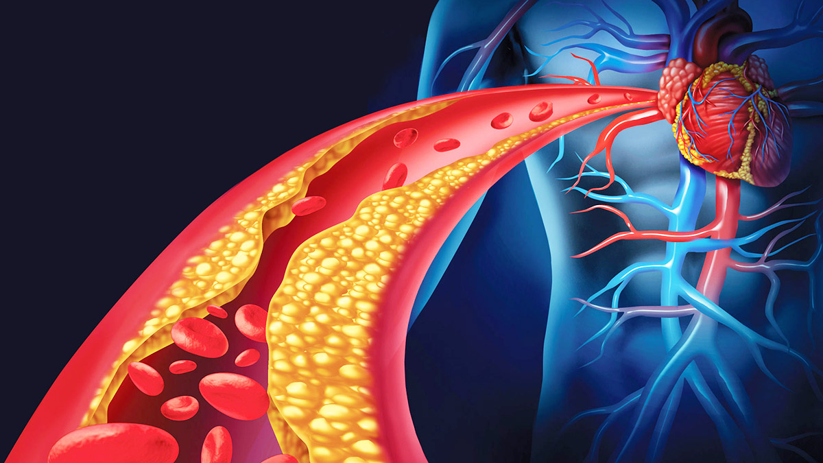 Dëmet që i Shkakton Kolesteroli i Lartë Zemrës dhe Trurit - Kujdesi që ju Duhet