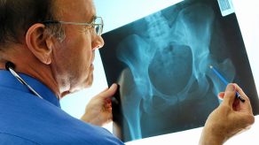 Gjashtë Shenjat Paralajmëruese të Osteoporozës - Si ta Shmangni