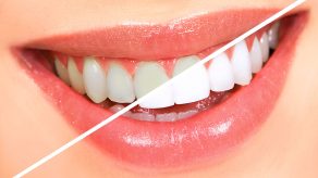Zbardhimi i Profesional Dhëmbëve – A është i Sigurtë dhe i Shëndetshëm?