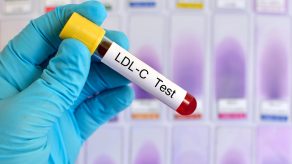 5 Faktorë që Ndikojnë në Testet e Kolesterolit